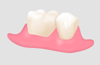 一般診療の部分入れ歯